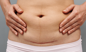 Sezaryen Doğum Sonrası İyileşme