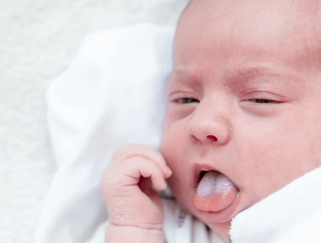 Yenidoğan Bebekte Pamukçuk