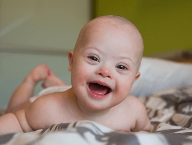 Down Sendromlu Bebek