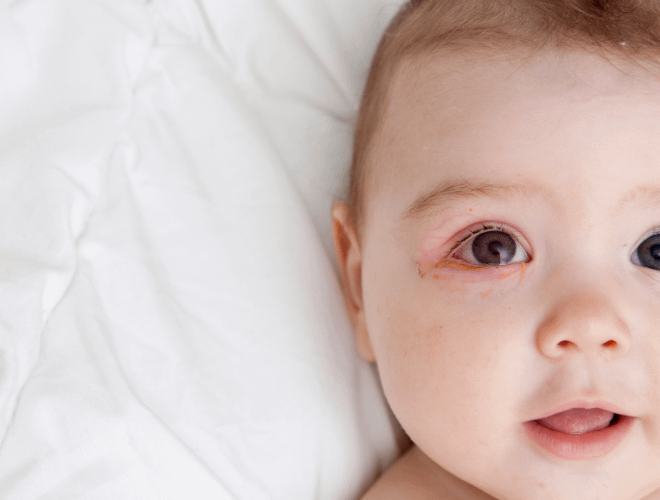 Yenidoğan Bebeklerde Göz Çapaklanması