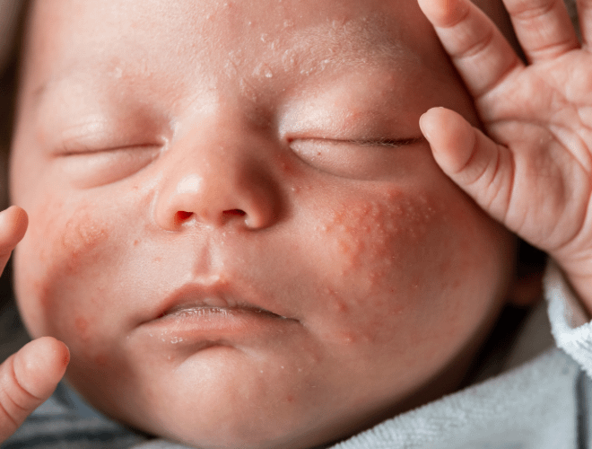 Yenidoğan Sivilcesi Hakkında Her Şey