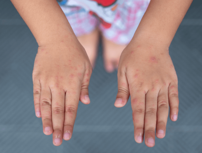 El Ayak Ağız Hastalığı