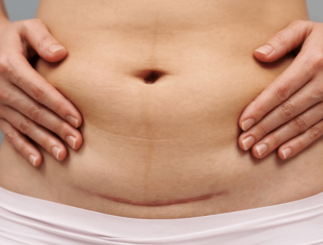 Sezaryen Doğum Sonrası İyileşme