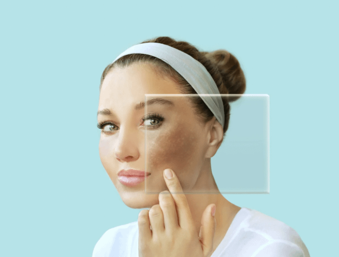 Gebelik Maskesi (Melazma) Nedir? Neden Oluşur ve Nasıl Geçer?