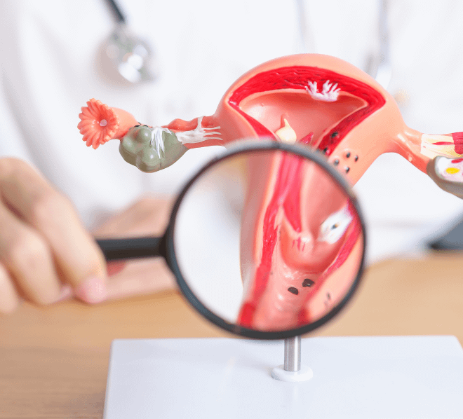 Endometriozis Kısırlık Yapar Mı?