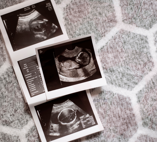 1. Trimesterda Mide Bulantısı